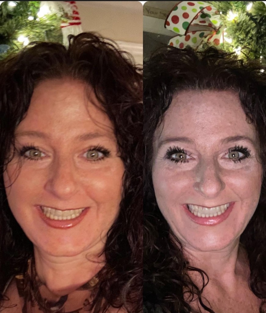 My results for avoiding Ozempic Face