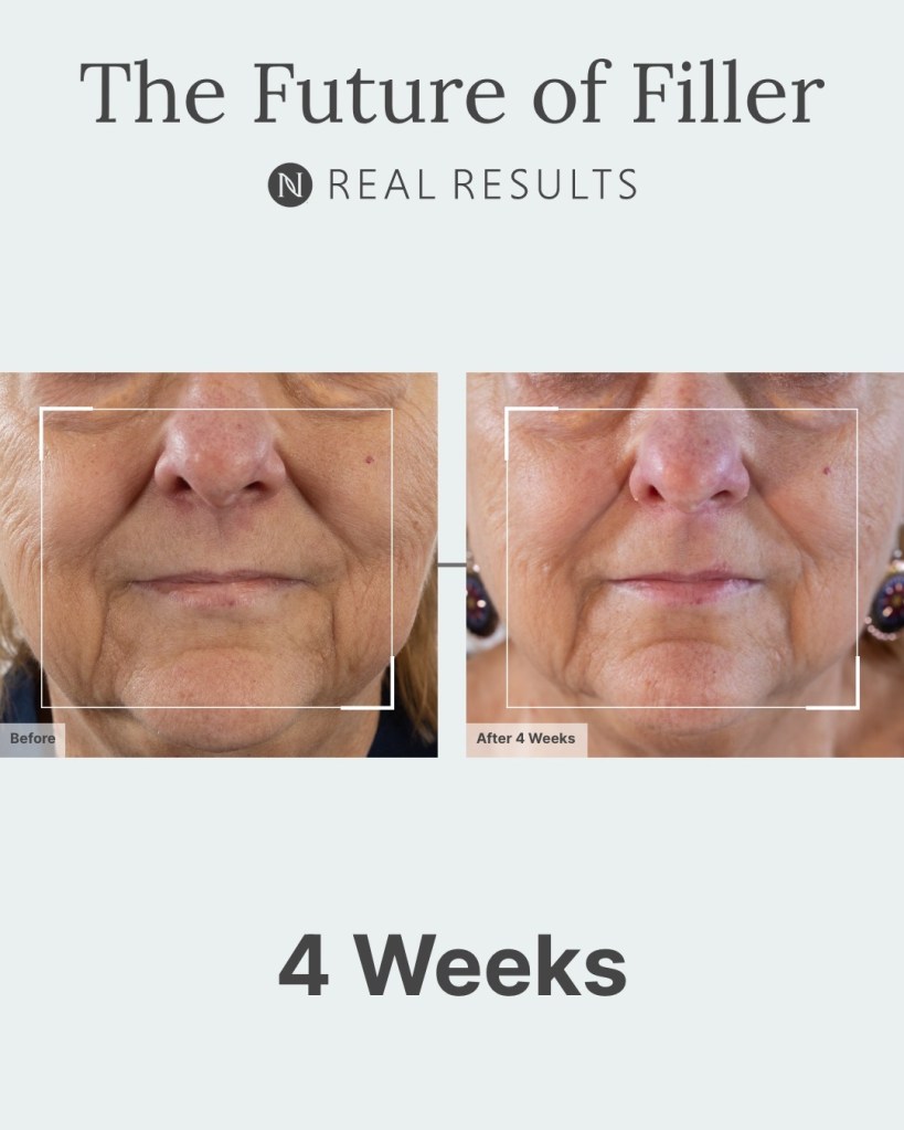 The Future of Filler Real Results tighten up those jowls