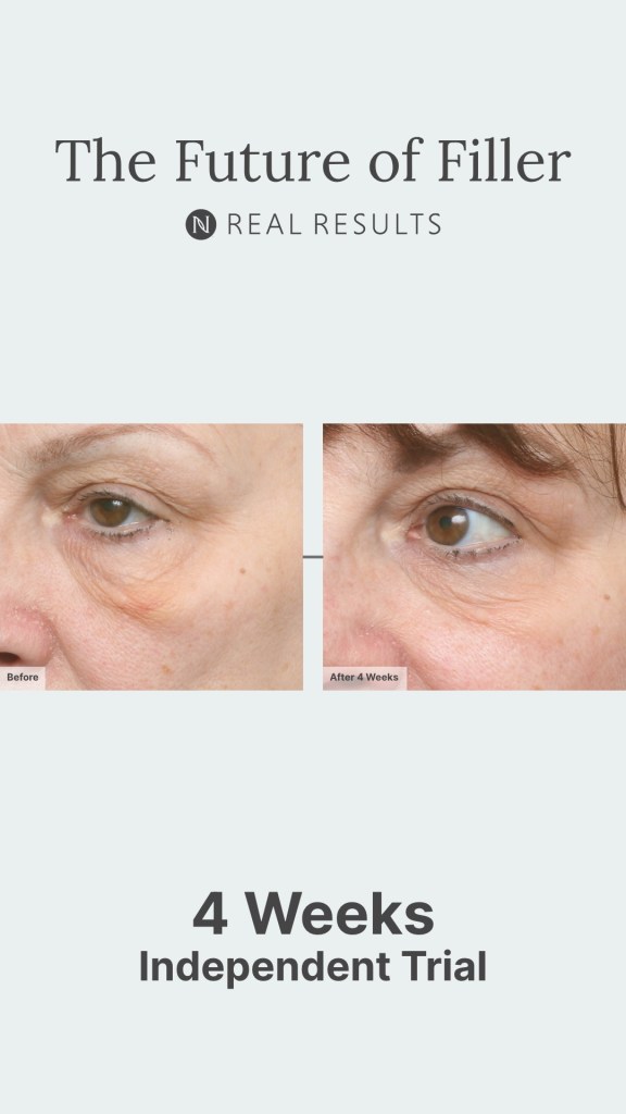 The Future of Filler clinical trial results
