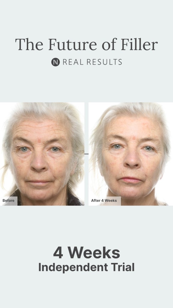 Future of Filler 4 week results from independent trial